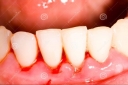 6 loại bệnh răng miệng thường gặp