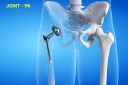 Viêm khớp háng: Nguyên nhân - Dấu hiệu - Điều trị - Phòng ngừa